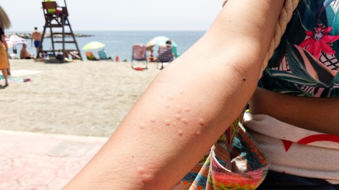 symptome piqure de meduse